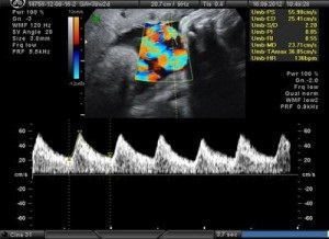 Dopplerometria în timpul sarcinii ce este?