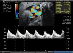 Doppler terhesség alatt is
