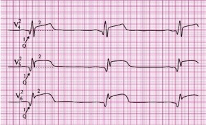 Semne ECG de infarct miocardic acut
