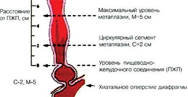 Diagnosticul endoscopic al esofagului barretului