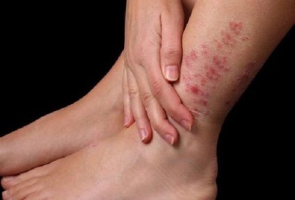 Herpesul pe picior fotografii, simptome și tratament - vii sănătoși