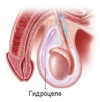 Hidrocele cauzează, tratament, simptome