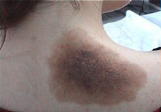 Pigmentul gigant cauzează nevus, simptome, diagnostic și tratament