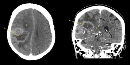 Simptomele și prognosticul gliocarcinomului cerebral