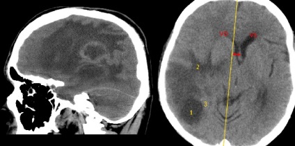 Simptomele și prognosticul gliocarcinomului cerebral