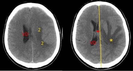 Simptomele și prognosticul gliocarcinomului cerebral