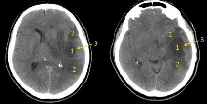 Simptomele și prognosticul gliocarcinomului cerebral