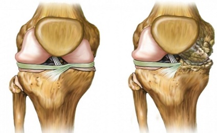 Osteoarthritis 3 fok térdműtét kezelés nélkül, lépések, arthrosis deformans,