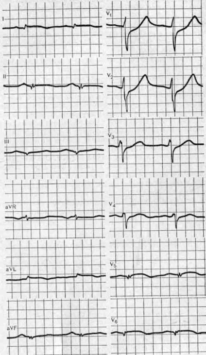 Infarctul peretelui lateral al ventriculului stâng - schimbări în ec - studiul activității electrice