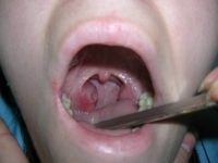 Mononucleoza infecțioasă la copii și adulți simptome foto, cauze și tratamentul bolii