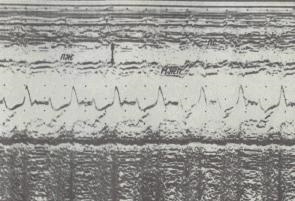 Examenul ventriculului drept - ecocardiografia generală - diagnosticul cu ultrasunete în cardiologie