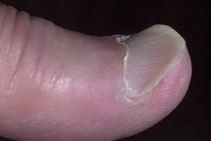 Cum să diagnosticați, să determinați boala prin unghii sau picioare