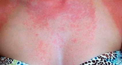 Cum sa recunoasca si sa trateze dermatita soarelui prin diferite metode