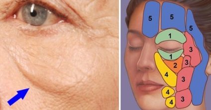 Cum să eliminați sufixul pe fața cauzei apariției pungilor de vopsea sub ochi - stabilirea sănătății