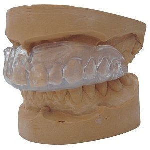 Capa cu tipuri de bruxism, procedura de fabricatie, preturi