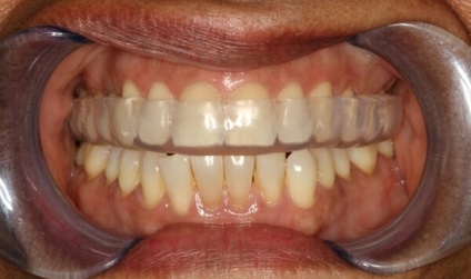 Capa cu tipuri de bruxism, procedura de fabricatie, preturi