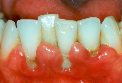 Un buzunar în gumă între dinți cum să tratați inflamația la domiciliu