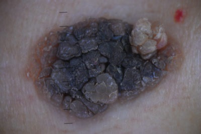 Keratopapilloma a pielii ce este, cum se trateaza si se indeparteaza pe corp