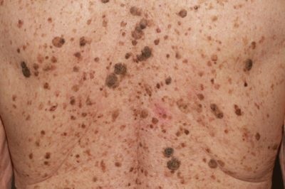 Keratopapilloma a pielii ce este, cum se trateaza si se indeparteaza pe corp