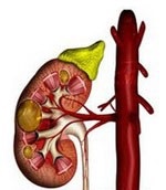 Kista din rinichi, cauzează tratamentul cu metode populare