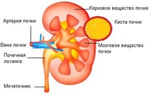 Kista din rinichi, cauzează tratamentul cu metode populare