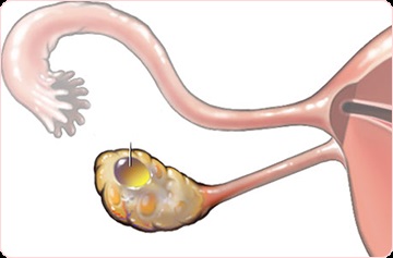 Chist ovarian, centrul de ginecologie din Moscova