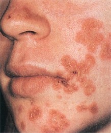 Impetigo de piele - care sunt cauzele, simptomele, tratamentul