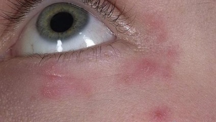 Locurile roșii sub ochi (cauze, simptome, tratament)
