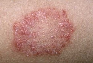 Roșu Ringworm Flat - cauze, simptome și tratament