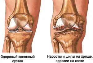 Tratamentul artrozei, artrozei articulației genunchiului