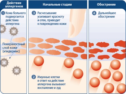 Tratamentul dermatitei atopice la copii