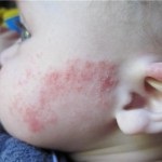 Tratamentul dermatitei atopice la copii