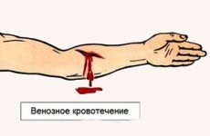 Vérzés kezelése népi jogorvoslati