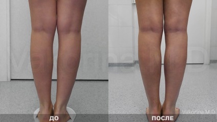 Lipofilling fața, buzele din Moscova, prețul lipoplasty nasolabial falduri cu grăsime