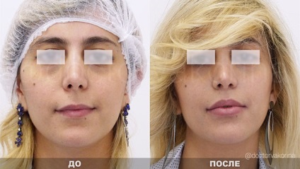 Lipofilling fața, buzele din Moscova, prețul lipoplasty nasolabial falduri cu grăsime