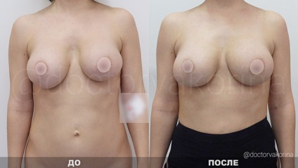 Lipofilling fața, buzele din Moscova, prețul lipoplasty nasolabial falduri cu grăsime