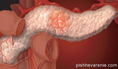 Lipomatosis a hasnyálmirigy