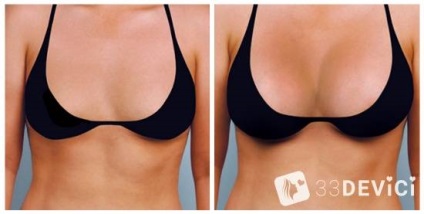 Breast mammaplasty comentarii, preț, fotografie înainte și după