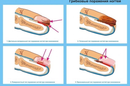 A kálium-permanganát köröm gombás kezelésére és megelőzésére receptek