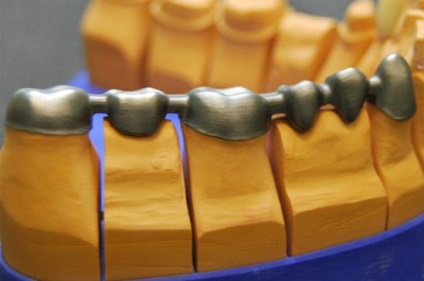Proteză ceramică metalică a dinților - proteză - Vreau să știu totul! Apatity