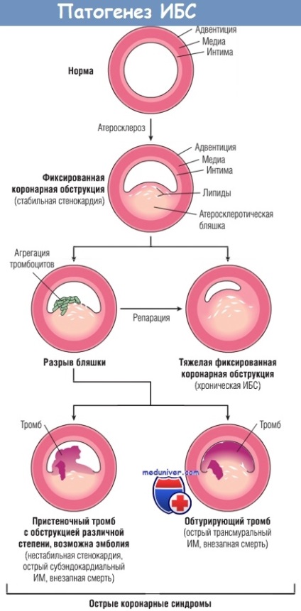 Mecanisme de dezvoltare (patofiziologie) a infarctului miocardic