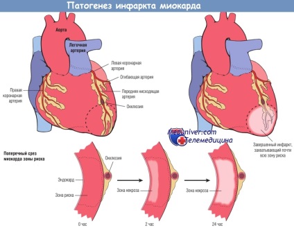 Mecanisme de dezvoltare (patofiziologie) a infarctului miocardic
