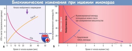 Mecanisme de dezvoltare (patofiziologie) a infarctului miocardic