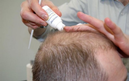 Minoxidil Hair olvasmányok, használata, igazi férfiak és nők, blog haj