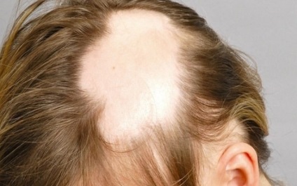 Minoxidil Hair olvasmányok, használata, igazi férfiak és nők, blog haj