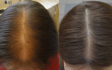 Minoxidil pentru indicații de păr, utilizare, recenzii de bărbați și femei, blog despre păr