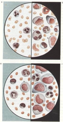 Mononucleosis (változások a vérben) - fertőző mononucleosis - Fertőző betegségek a gyermekek - Gyermekek -