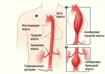 Aorta mortală a părților toracice și abdominale