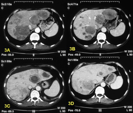 Mert al ficatului care arată (tomografie cu contrast)