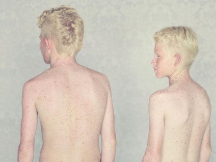 Nem úgy, mint minden ember, az albínók - Hírek képekben